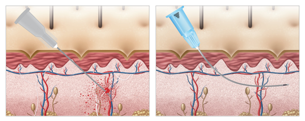 Benefits of Filler Injections with Microcannulas – Aesthetic Technique by AIAM Trainings